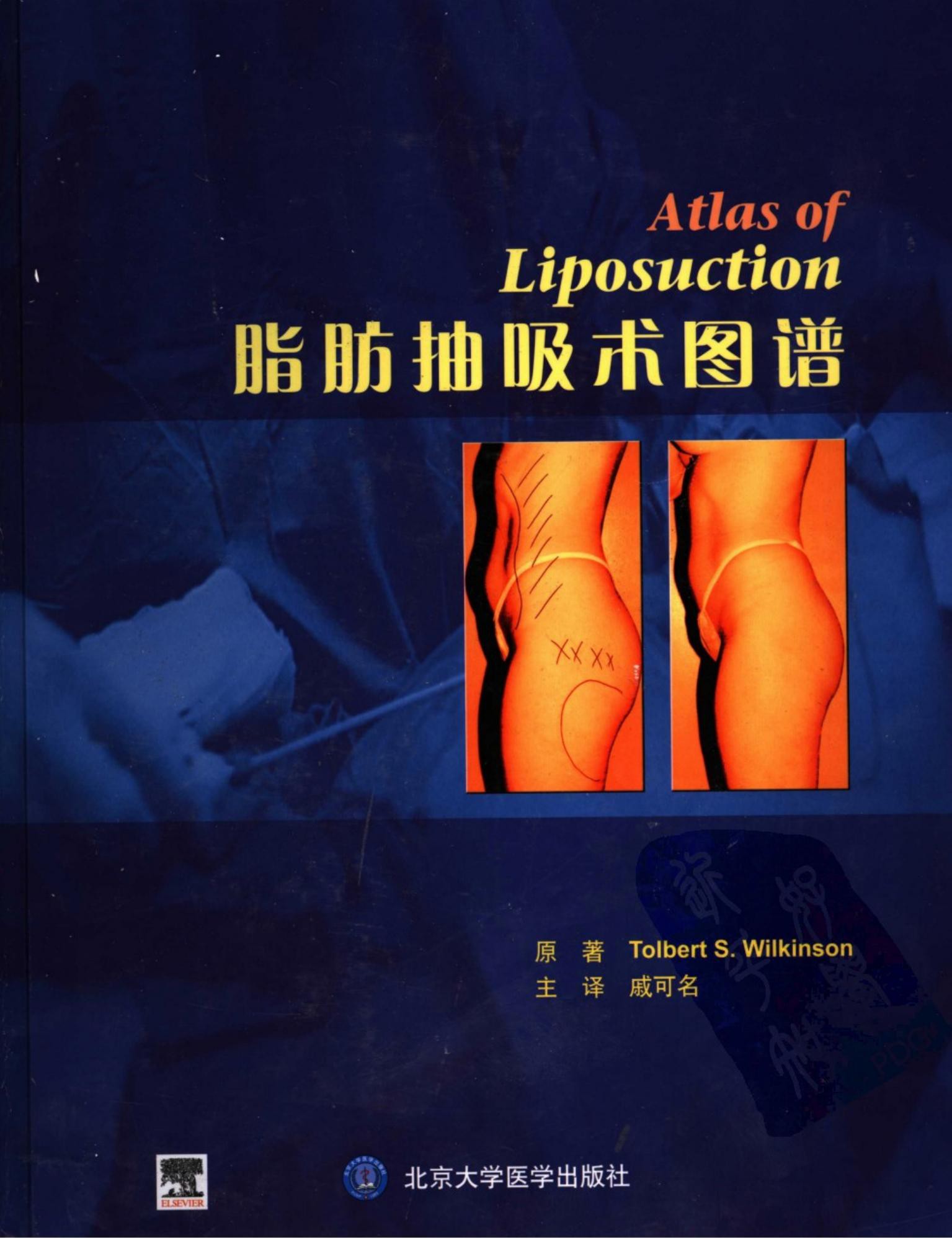 脂肪抽吸术图谱